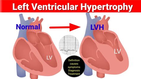 lv medical abbreviation|treatment for Lv hypertrophy.